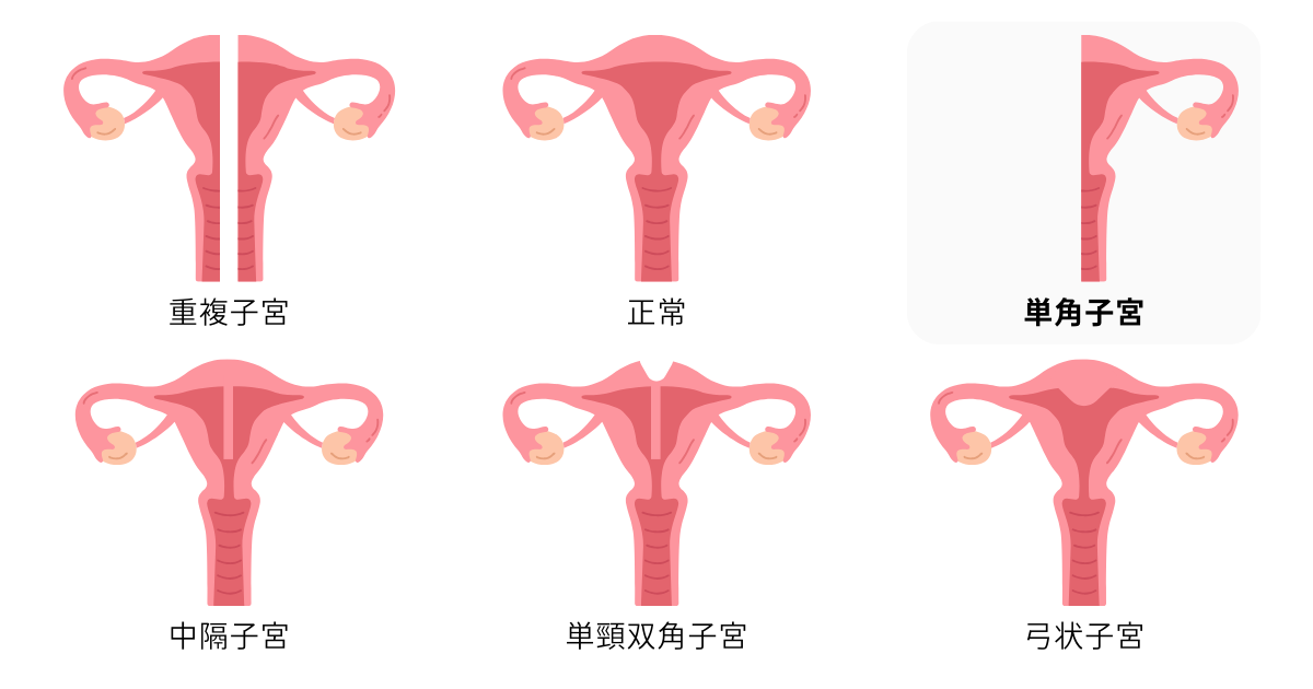 子宮奇形