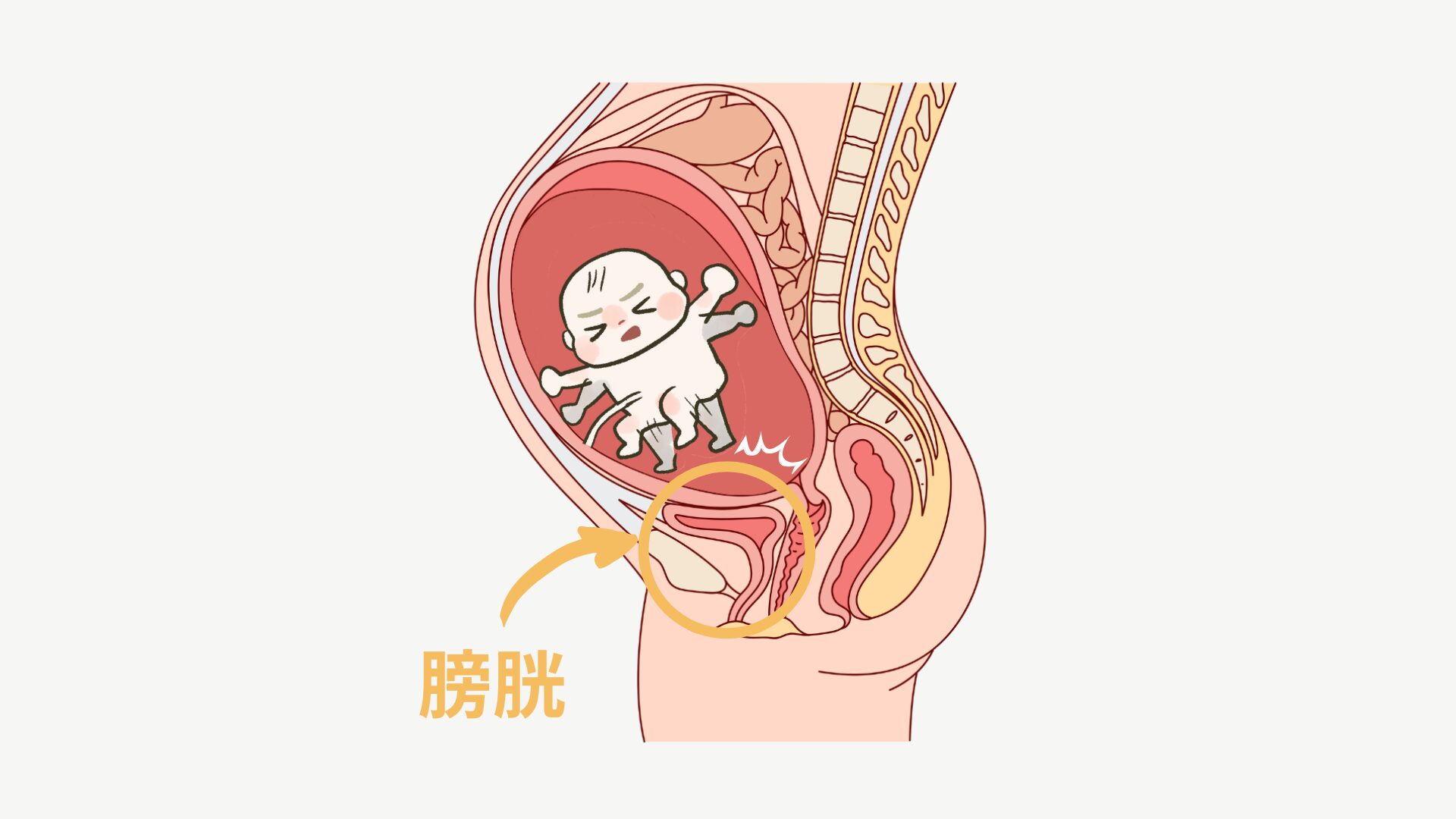 逆子と膀胱の位置関係